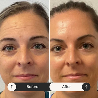 Facial cupping set