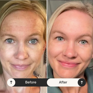 Facial cupping set