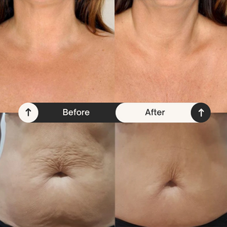Body cupping set